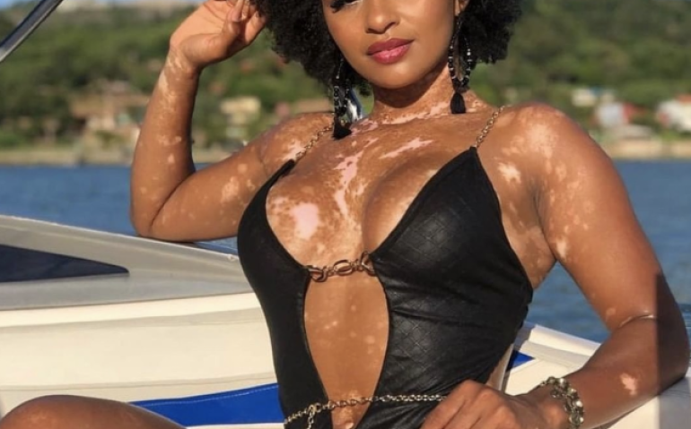 vitiligo-o-maior-dano-e-o-causado-pelo-preconceito-4def